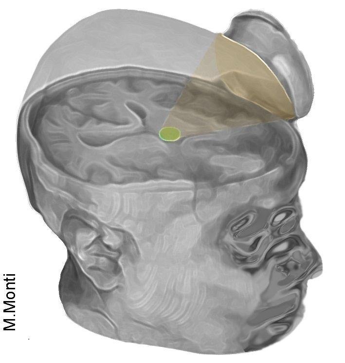 thalamus ultrasound